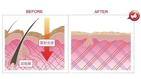 星雷射的長脈衝模式可使熱能直達真皮層，重建膠原蛋白結構，達到緊緻毛孔同時可加熱收縮皮膚腺