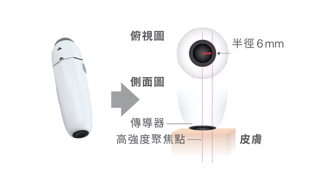 筆狀手握把設計，治療過程不再受探頭尺寸侷限