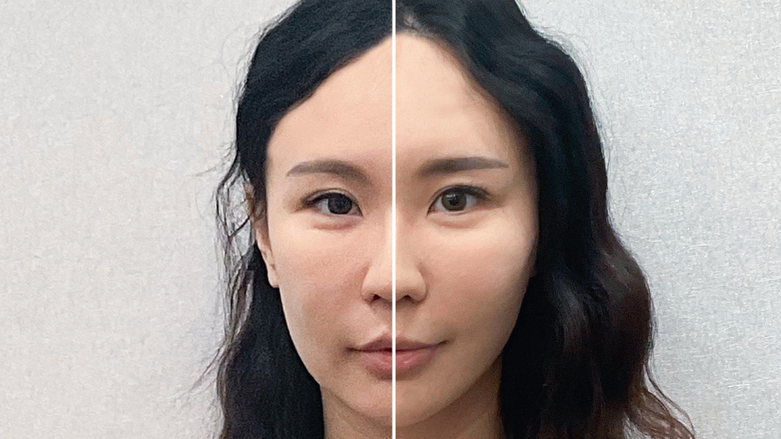 術前與術後對比：臉頰明顯向上拉提，輪廓線條更加分明
