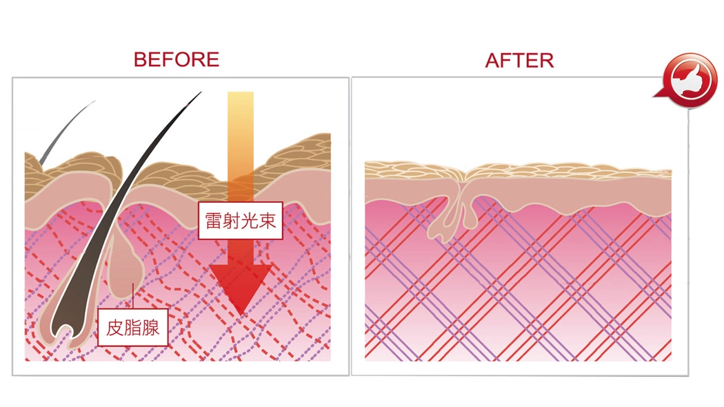星雷射的長脈衝模式可使熱能直達真皮層,重建膠原蛋白結構,達到緊緻毛孔同時可加熱收縮皮膚腺