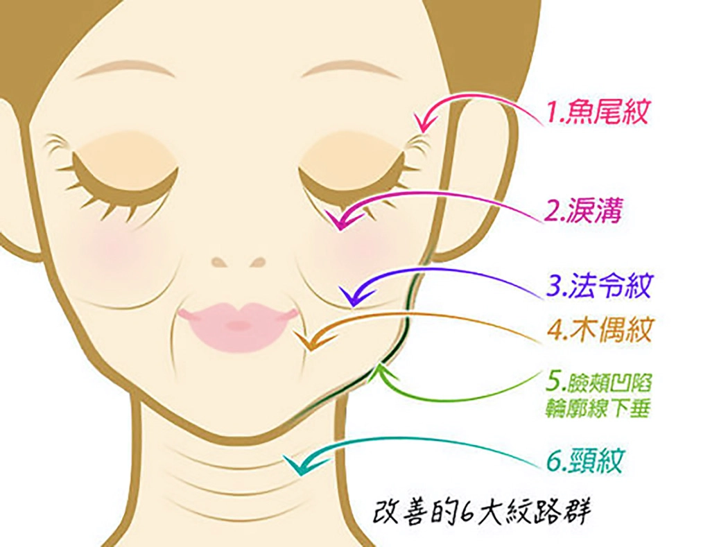 魚尾紋：讓笑容不再洩露年齡的秘密，保持眼周的明亮神采。淚溝：告別疲憊感，讓眼下肌膚重新飽滿有光澤。法令紋：改善嘴角兩側深紋，找回年輕柔和的臉部線條。木偶紋：提升嘴角弧度，重拾自然開朗的表情。臉頰凹陷與輪廓下垂：恢復臉部飽滿度與立體輪廓，展現精緻面容。頸紋：撫平頸部歲月痕跡，讓妳從臉到頸都維持優雅姿態。