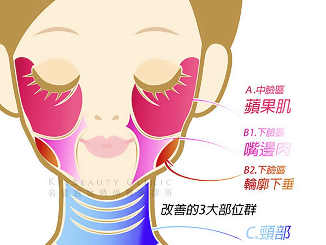 A. 中臉區－蘋果肌：恢復中臉飽滿度，重現甜美立體的倒三角臉型，讓妳的笑容充滿活力。B1. 下臉區－嘴邊肉：改善因鬆弛而下垂的嘴邊贅肉，重新定義下顎輪廓線。B2. 下臉區－輪廓下垂：全面拉提下半臉線條，從側面看也擁有俐落的V型曲線。C. 頸部：頸部是最容易顯露歲月的部位之一，透過埋線拉提改善頸紋與鬆弛，讓妳的優雅從容由內而外展現。