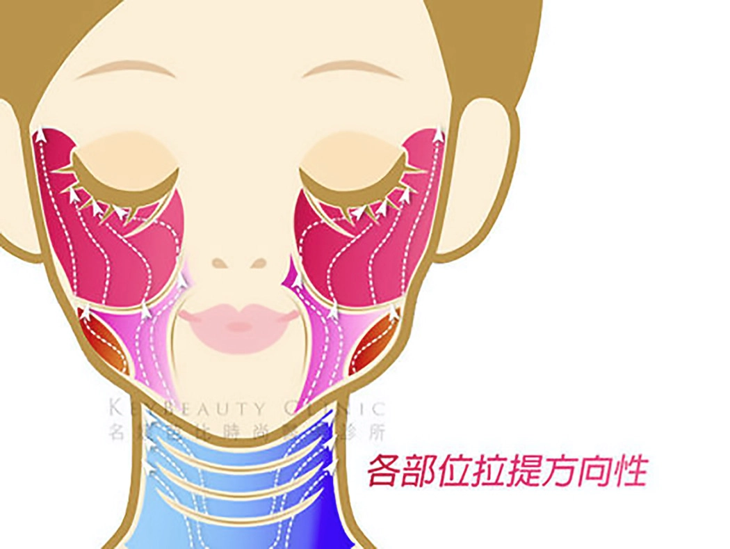 埋線拉提的方向性至關重要——由臉部兩側向後上方拉提，搭配耳前及太陽穴區域的固定點。精準的拉提方向能有效提升臉部立體感，讓輪廓更加緊實分明，同時淡化細紋與皺紋，呈現自然年輕的效果。