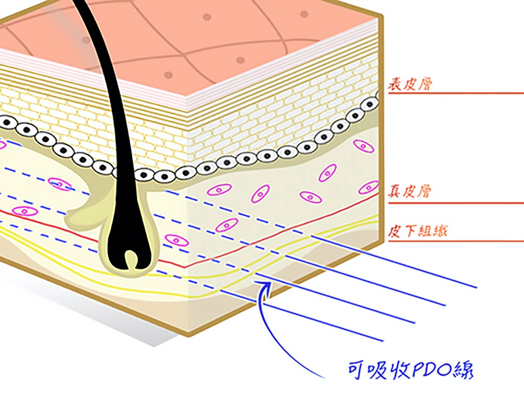 PDO線材由醫療級可吸收材料製成，透過細針植入皮下真皮層或筋膜上，將鬆弛的組織集中並向上拉提。線材的倒鉤結構提供穩固的支撐力，同時在體內持續刺激膠原蛋白增生，讓肌膚從內在恢復緊緻與彈性。