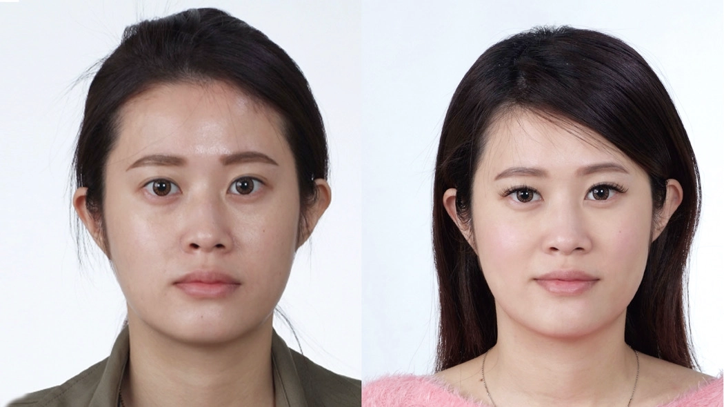 頻果肌上提，法令紋消失